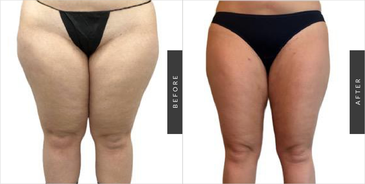 Liposuction Before-After