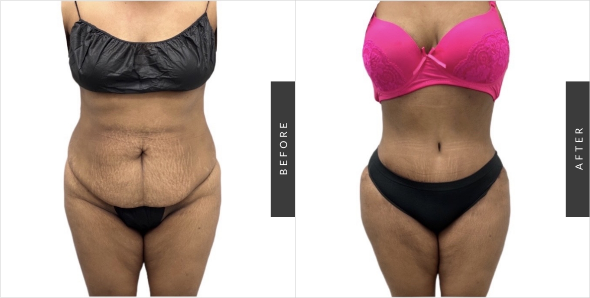 How Much Is A Tummy Tuck? - Millennial Plastic Surgery