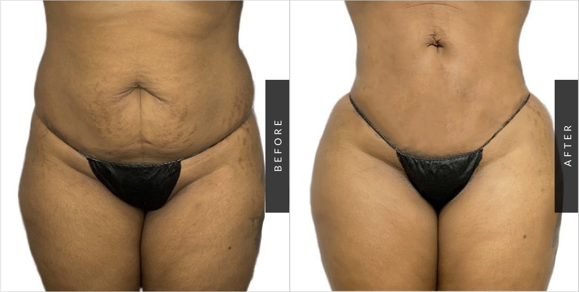 Tummy Tuck Before & After Patient 1183
