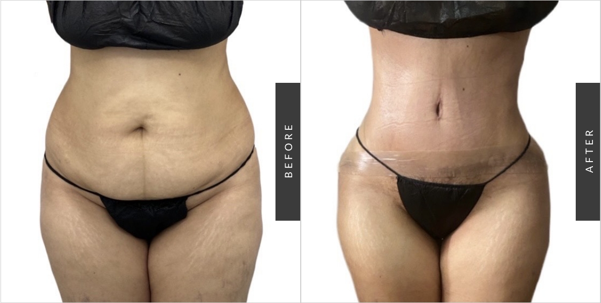 Tummy Tuck NYC 2 - Before-After