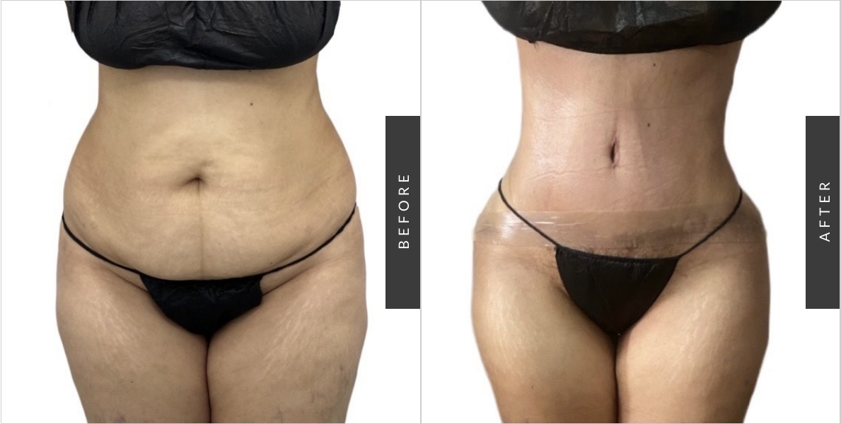 Full Tummy Tuck NYC  Full Abdominoplasty Manhattan & Bronx