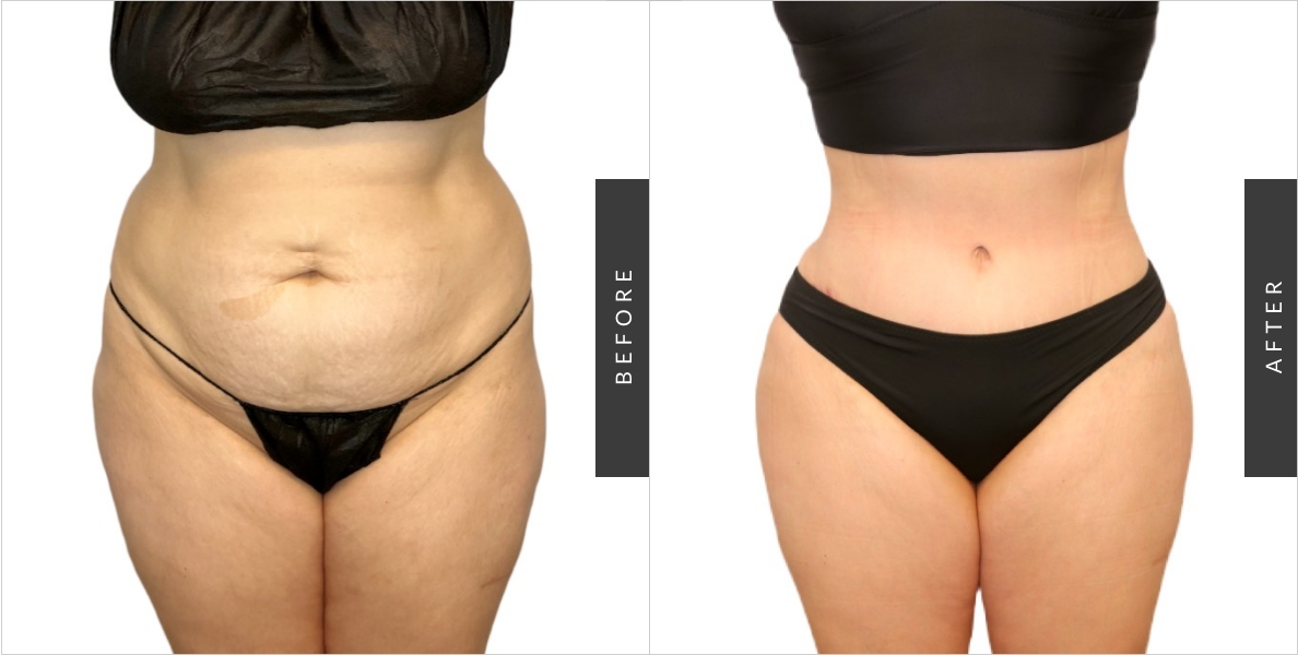 Tummy Tuck Before/After
