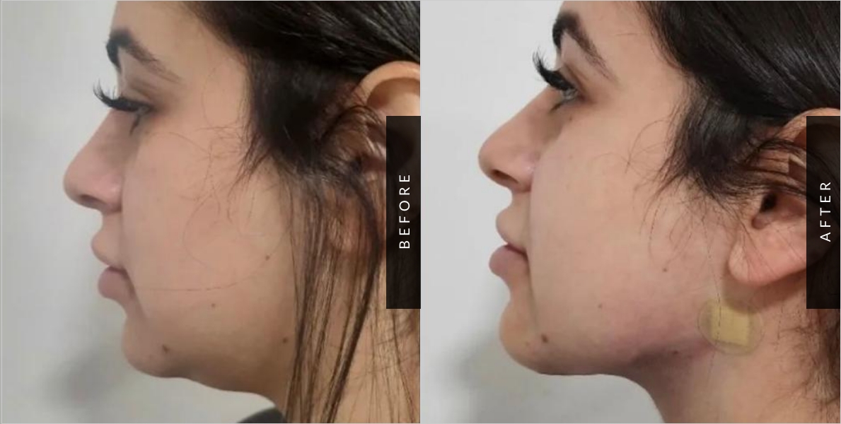 Chin Liposuction Before & After