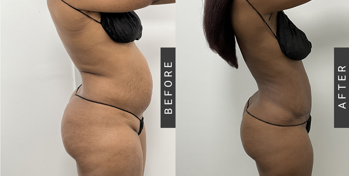 Tummy Tuck and Mommy Makeover Before & After Patient 1