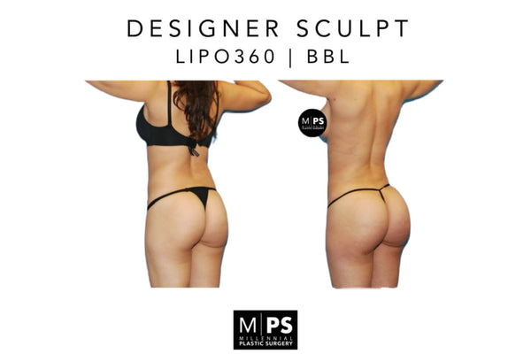 https://millennialplasticsurgery.com/wp-content/uploads/2023/10/liposuction-before-after.jpg