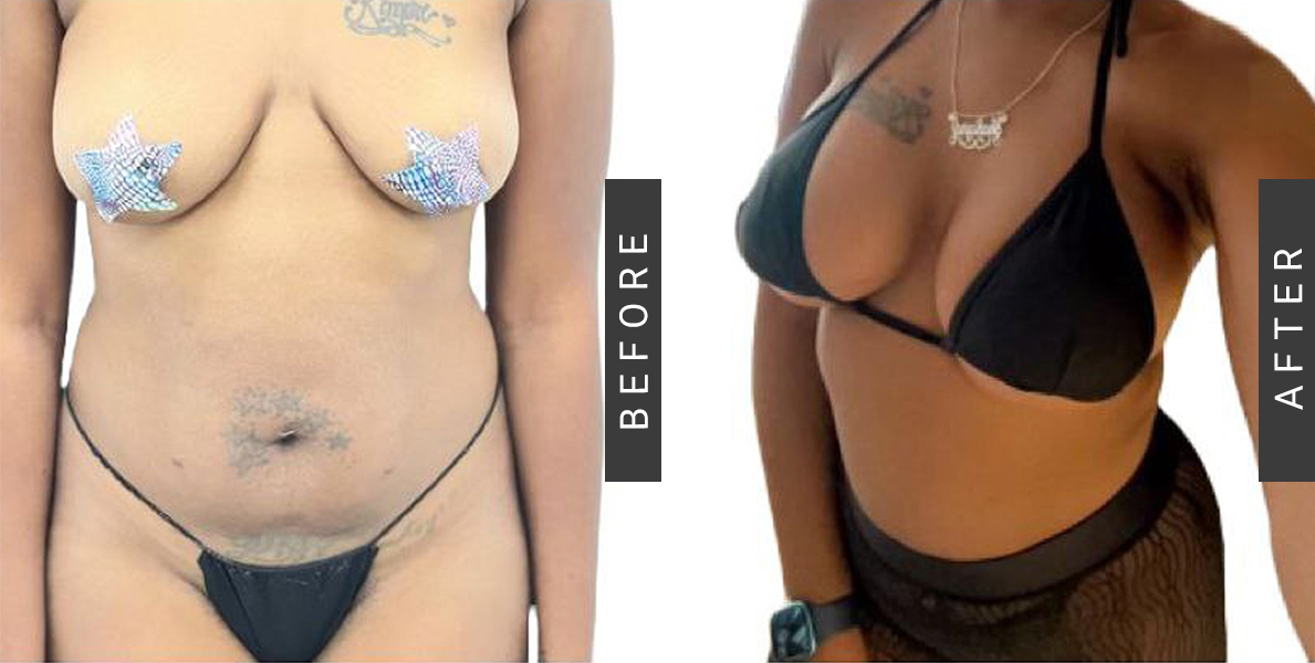 Breast Augmentation Before/After