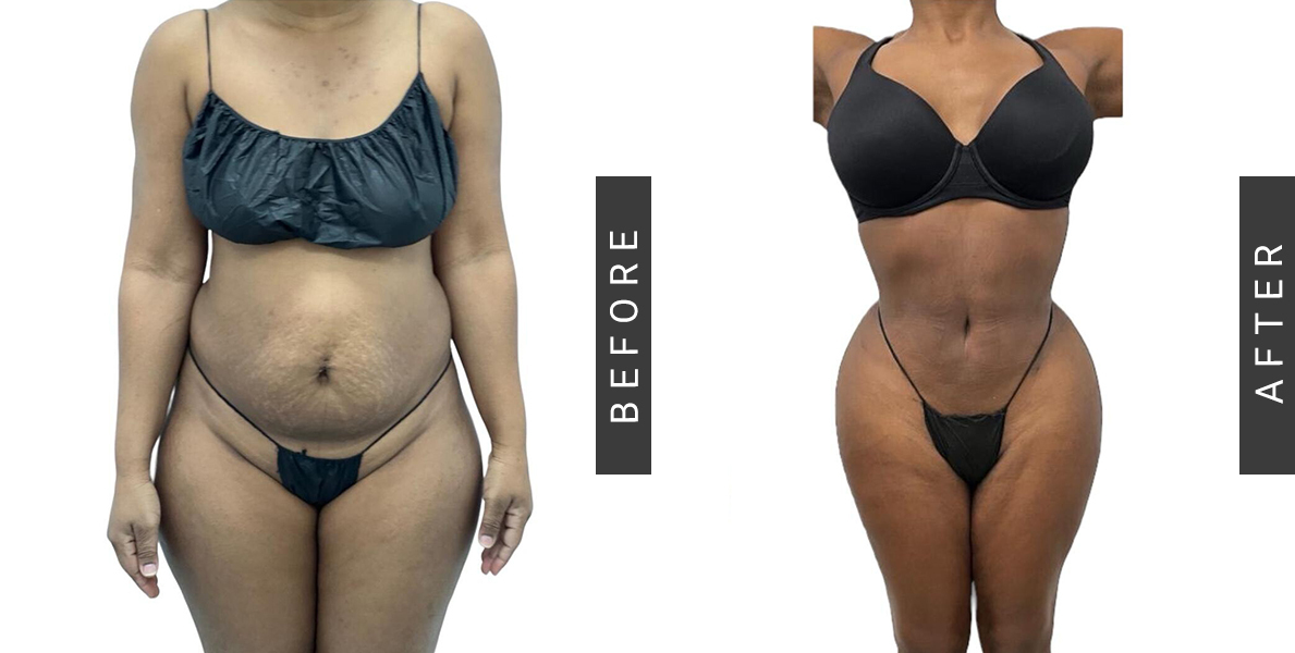 Before After Lipo-360