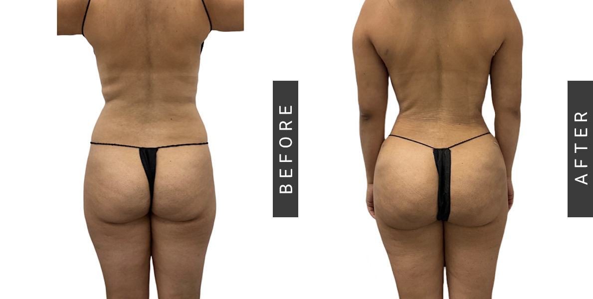 Before After Lipo-360 and Bruzilian Butt Lift