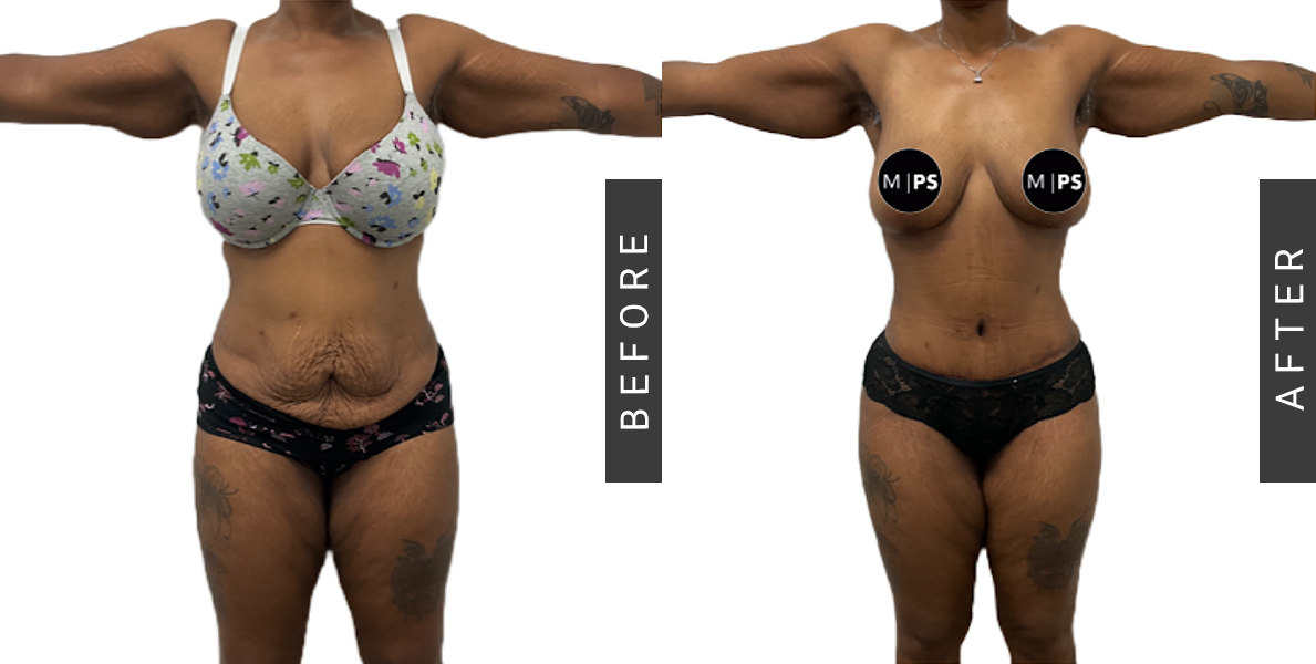 Tummy Tuck and Mommy Makeover 2 - Before-After
