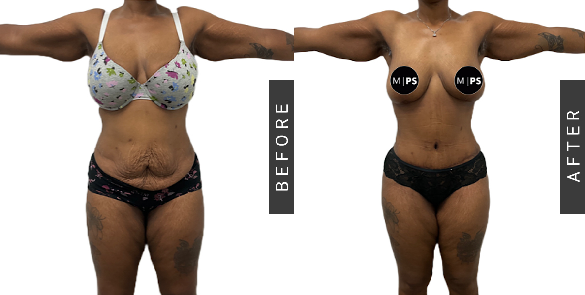 Before After Lipo-360