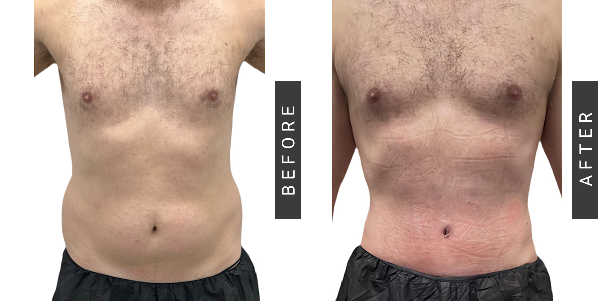 Male lipo360 and Tummy Tuck Before and After