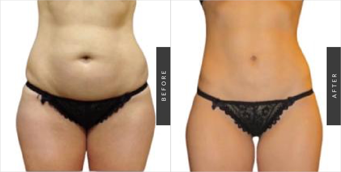 Liposuction by Dr. Shokrian Before and After 2