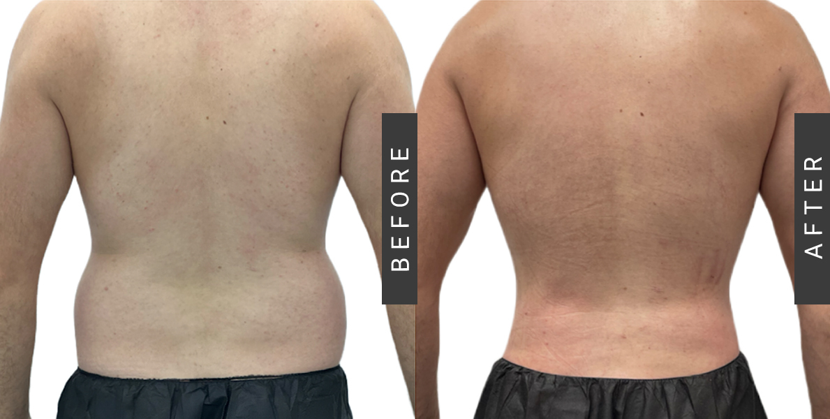 Hip Liposuction Before After