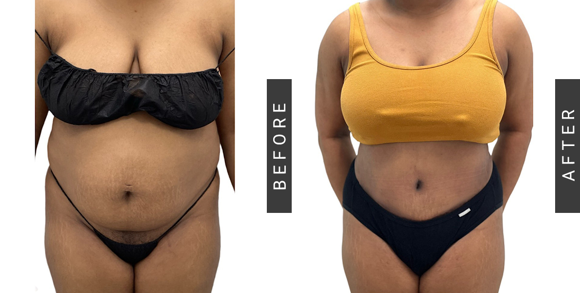 Lipo-360 Before and After
