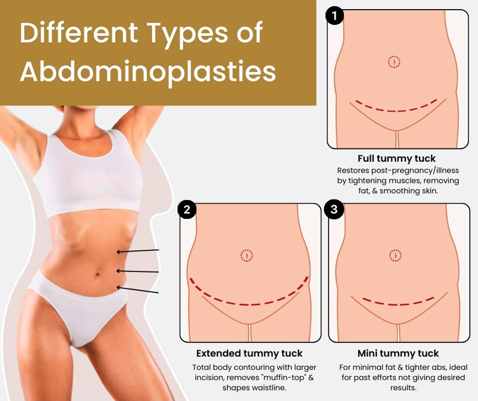 Different Types of Abdominoplasties