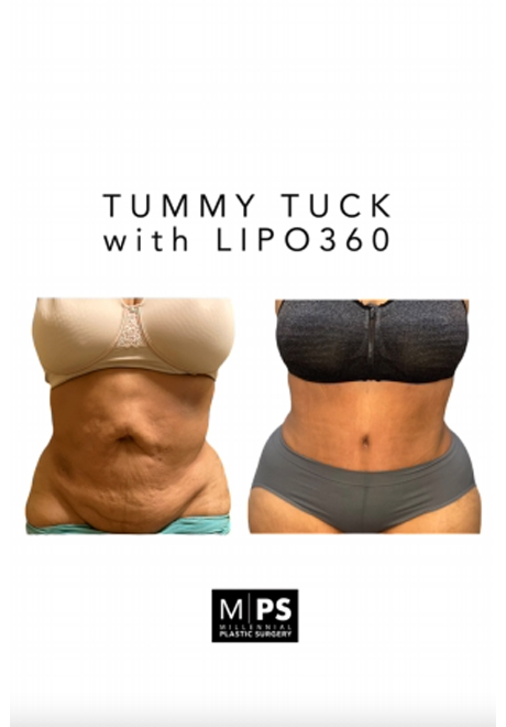 Madison Plastic Surgery - Tummy Tuck This is a lovely 57-year old woman.  1-year post-Op Over time, a taut, toned belly can lose its shape and sag.  Often these changes are resistant