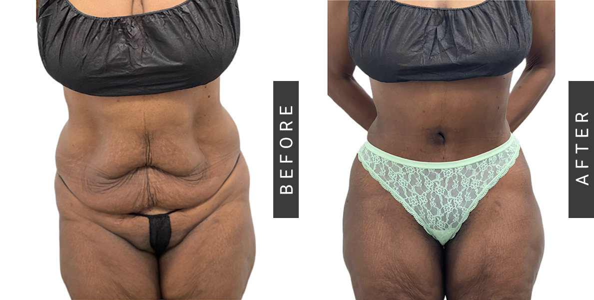 Tummy Tuck Surgery Before & After Patient 131