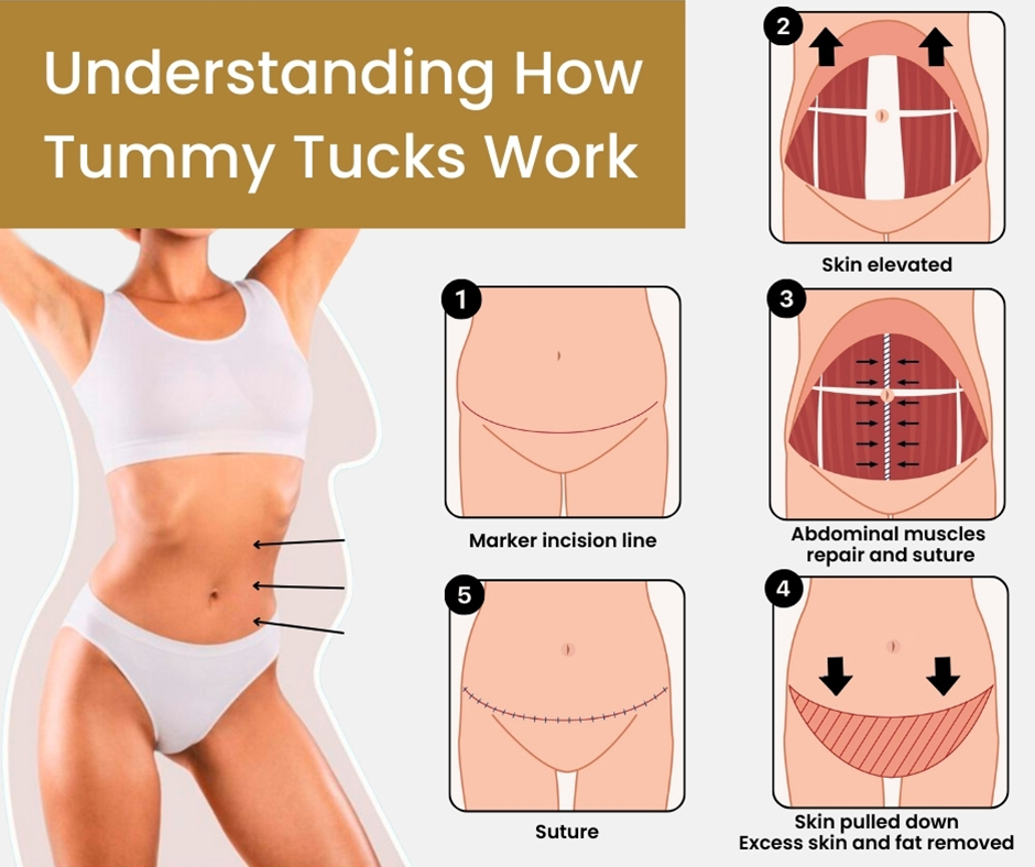 Understanding How Tummy Tucks Work
