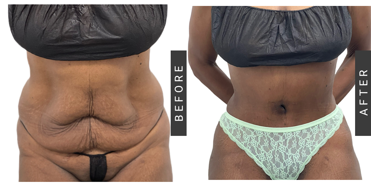 Lipo-360 and Tummy Tuck Before and After