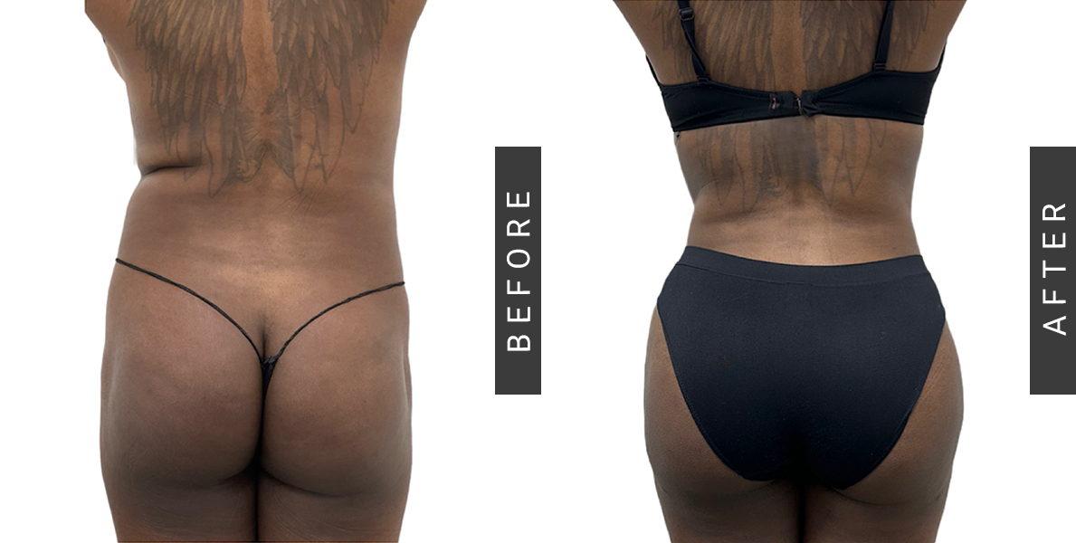Brazilian Butt Lift NYC  Awake BBL Surgery Manhattan & Bronx