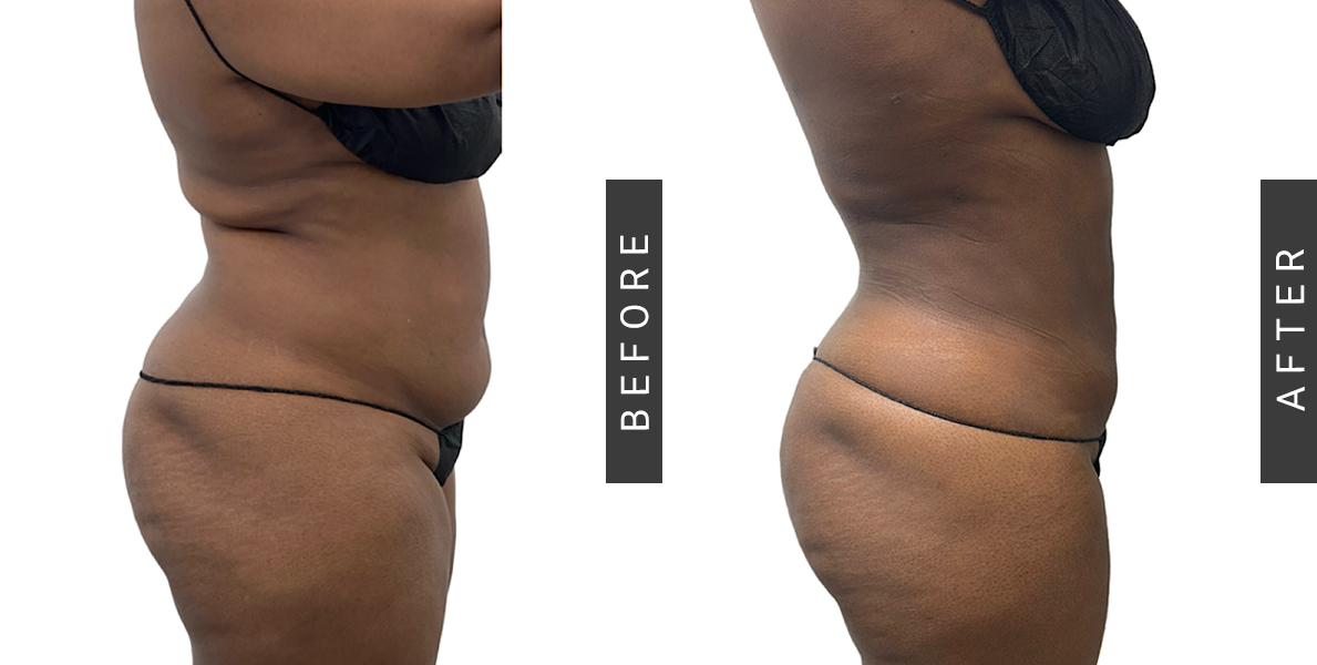 Lipo-360 Before and After