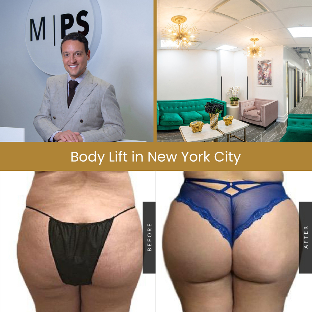 Lower Body Lift Before & After Patient 134, NYC