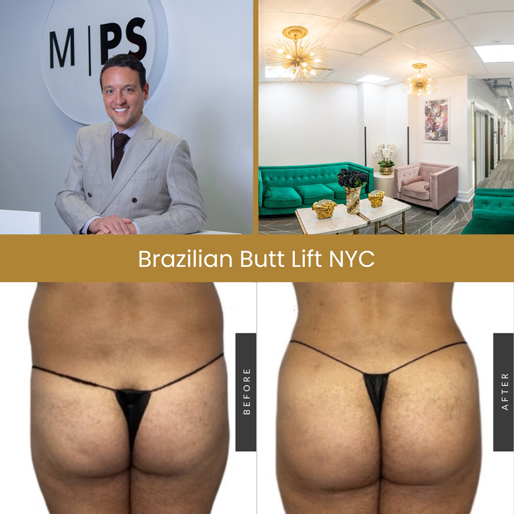 Awake Brazilian Butt Lift (BBL) - Salameh Plastic Surgery Center