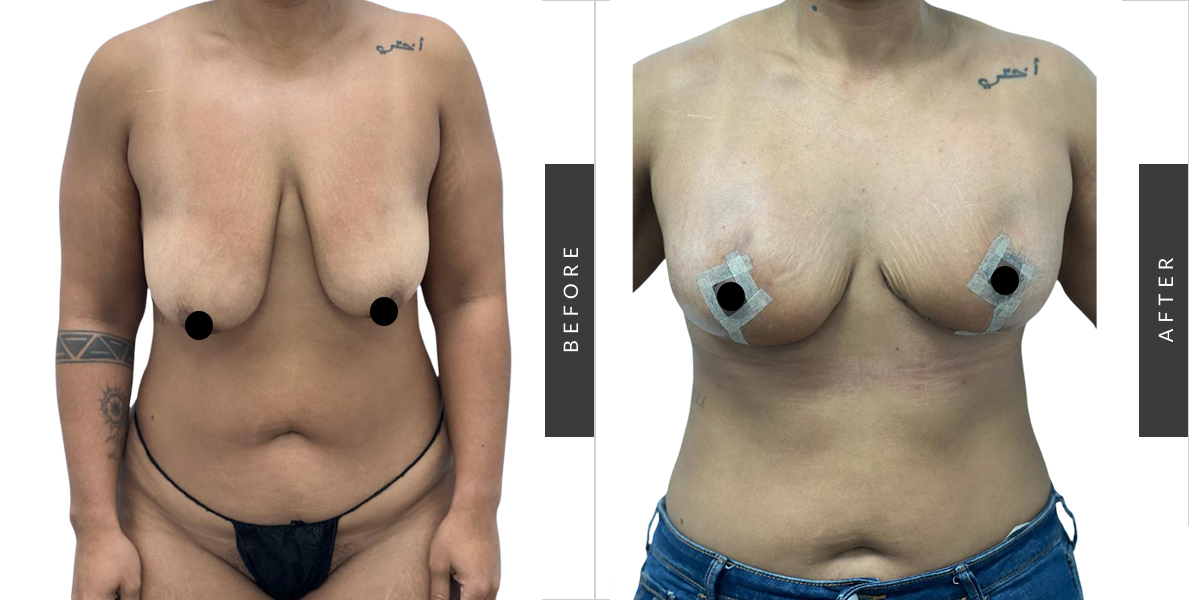 Breast Augmentation Before/After