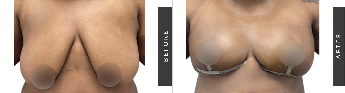 Breast Lift with Implants Before and After