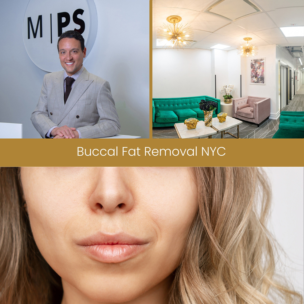 Buccal Fat Removal in NYC Dr. Shorkian Manhattan Cheek Reduction