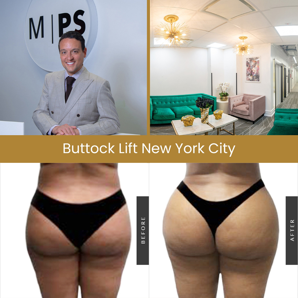 Sculptra Butt Lift NYC  Buttock Lift New York City