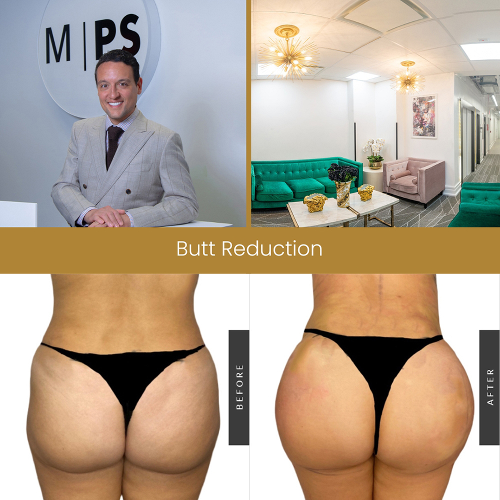 Butt Reduction NYC | Top Surgeon for Buttocks Lipo Manhattan & Bronx