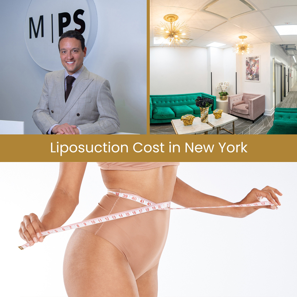Tummy Tuck Cost in NYC, NY: How Much Does Typically Cost With Tummy Tuck  Surgery? - Millennial Plastic Surgery