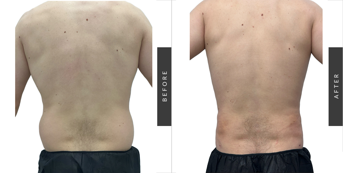 Male Body Sculpting Before and After