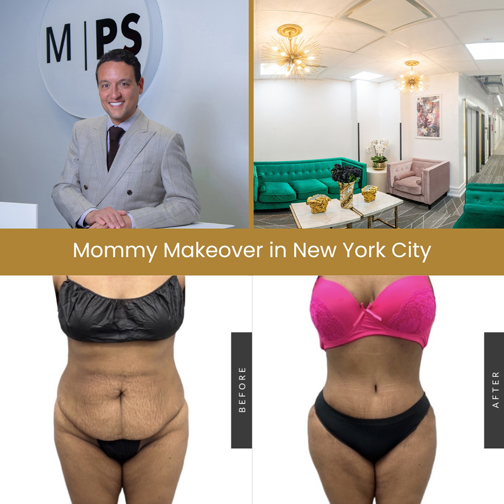 Tummy Tuck Cost in NYC, NY: How Much Does Typically Cost With Tummy Tuck  Surgery? - Millennial Plastic Surgery