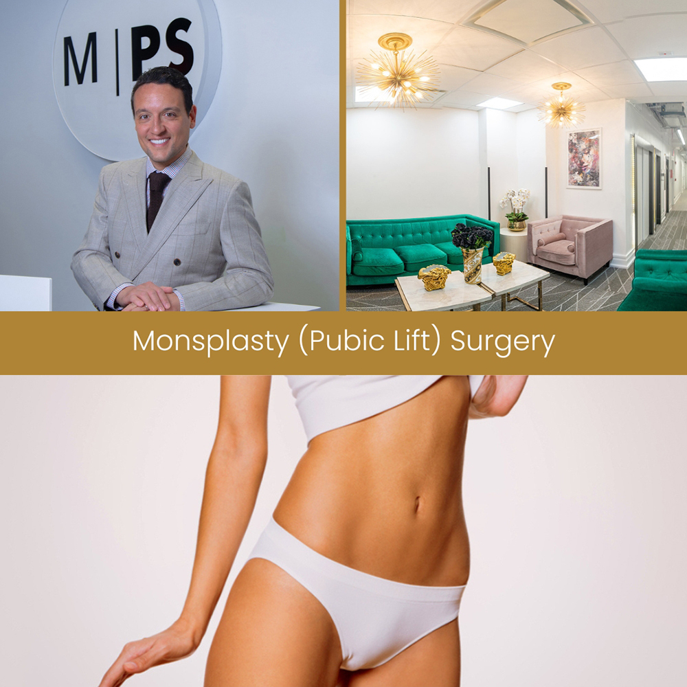 Monsplasty Benefits, Cost, and More | RealSelf Monsplasty near me