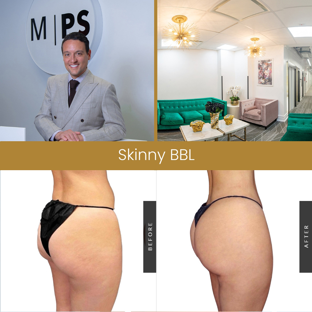 Skinny BBL NYC  Mini BBL Surgery in New York