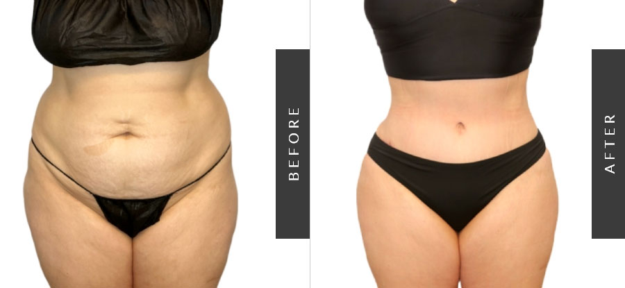 Tummy Tuck Before & After Patient 1183