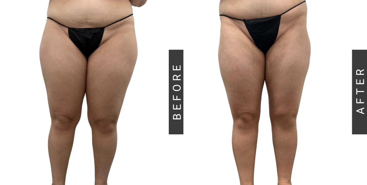 Things Calves Liposuction Before After