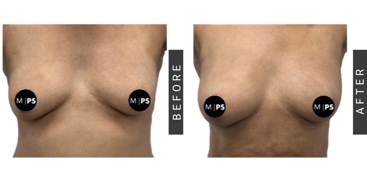 Breast Fat Grafting Before and After