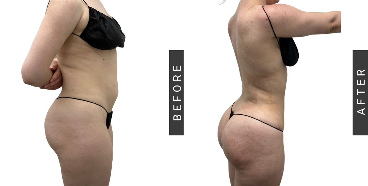 Lipo360 and BBL Before and After