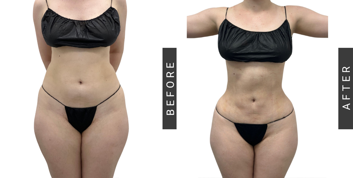 Lipo360 and BBL Before and After