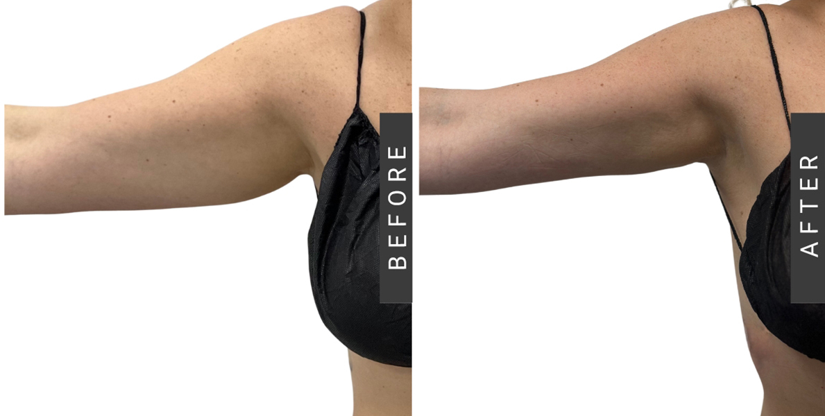 Arm Lipo Procedure Before-After