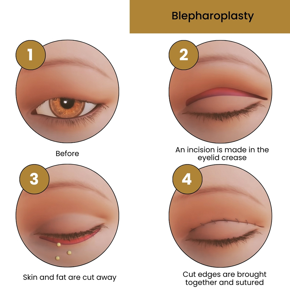 Blepharoplasty Eyelid Surgery