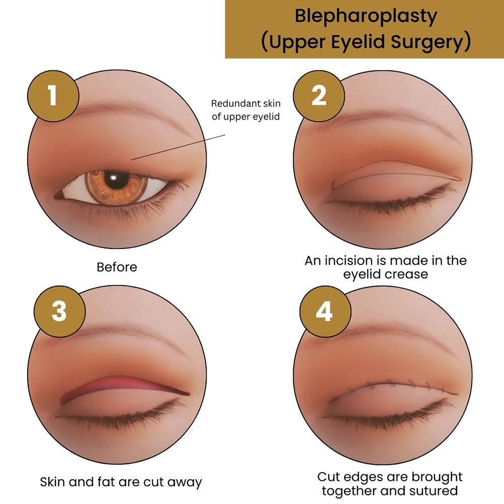 Blepharoplasty