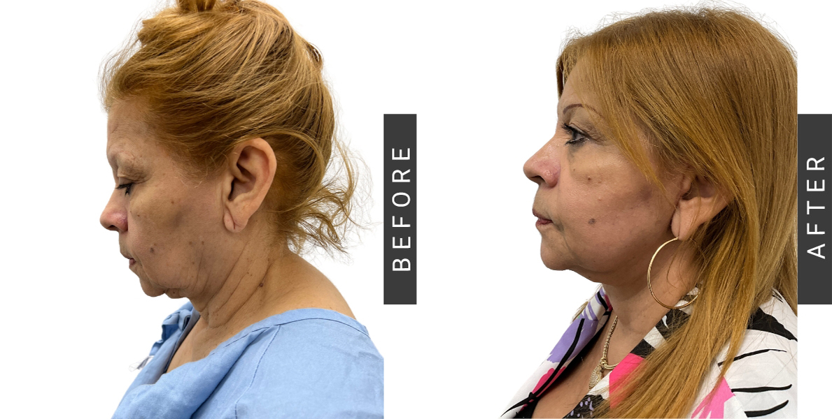 Facelift before & After