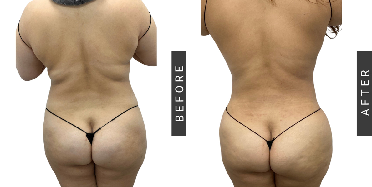 Lipo 360 Before and After NYC