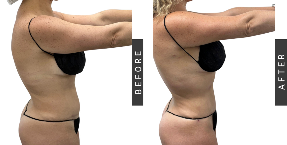 Lipo360 Before and After