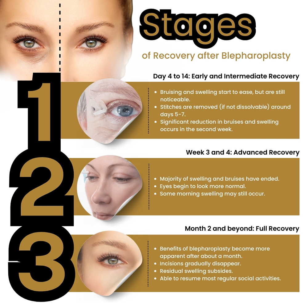 Stages of Recovery after a Blepharoplasty