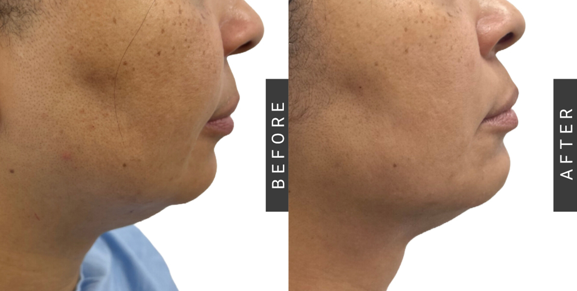 Jawline Sculpting Before After